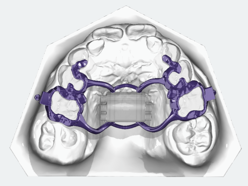 Tooth-Borne Rapid Palatal Expander