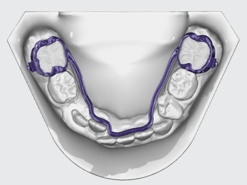 Lingual Arch - Image 2