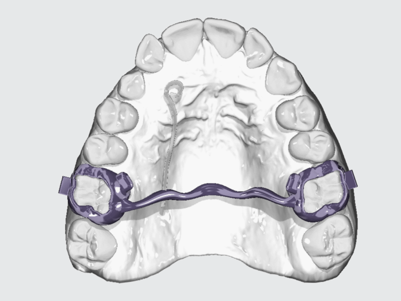 Lingual Arch